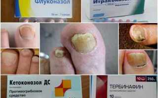 Лечение грибка ногтей: препараты недорогие, но эффективные и средства народной медицины для здоровья
