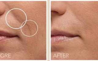 Belotero intense: отзывы о эффективности препарата для красоты